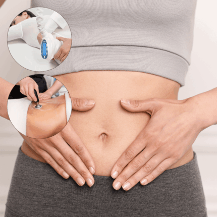 Pakiet zabiegów "Płaski brzuch" w Strefa Zdrowia Wilanów. 5x zabieg Icoone Laser Med+ 1 focus (abdoton/menzone) 6x zabieg Indiba na brzuch